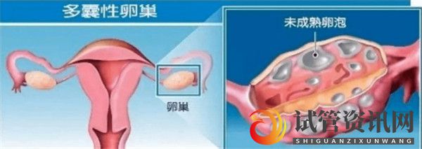 成都多囊卵巢综合征对试管婴儿成功率有哪些影响如何及时调理(图1)