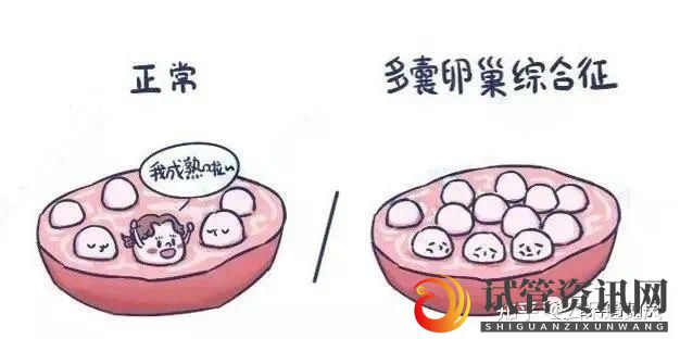 成都多囊卵巢做几代试管好(图3)