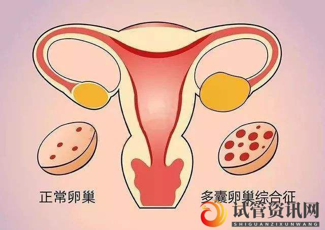 成都多囊卵巢综合的辅助检查有哪些(图1)