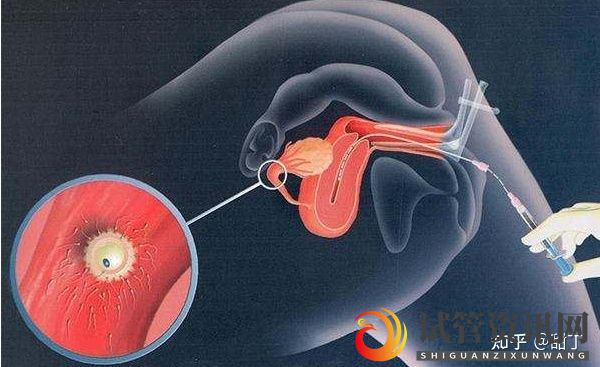 成都甜丁APP科普_人工受精成功率高吗__知乎_(图2)