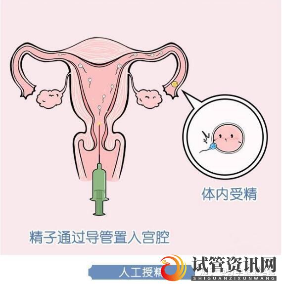 成都人工授精和试管婴儿适应症、费用、成功率的对比(图3)