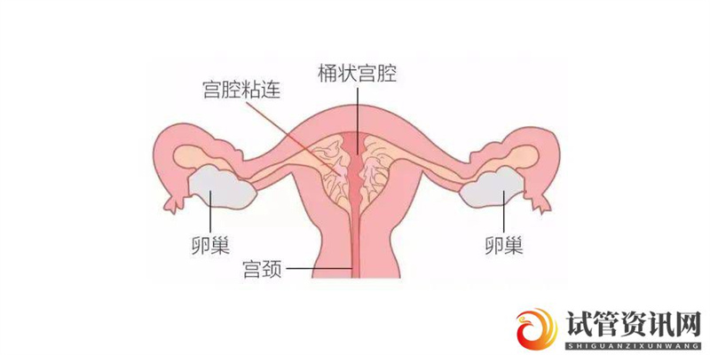 成都宫腔粘连可以做试管吗？成功率有多少？(图1)