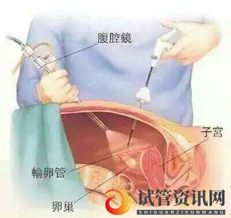 成都曾被诊断输卵管通而不畅,1个月逆转成功怀孕(图5)