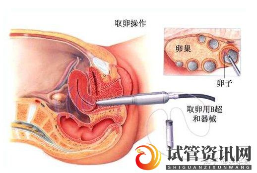 成都卵巢早衰做试管成功率高不高(图3)