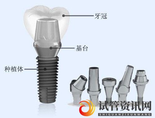 成都大连齿医生口腔科普种植牙的价格与什么有关种植牙手术有危险吗(图2)