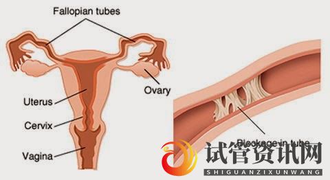 成都输卵管堵塞,怀孕到底有多难__知乎_(图6)