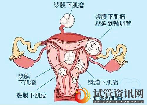 多发性子宫肌瘤可以做试管婴儿吗？你都了解吗(试管婴儿可以选择性别吗)(图1)