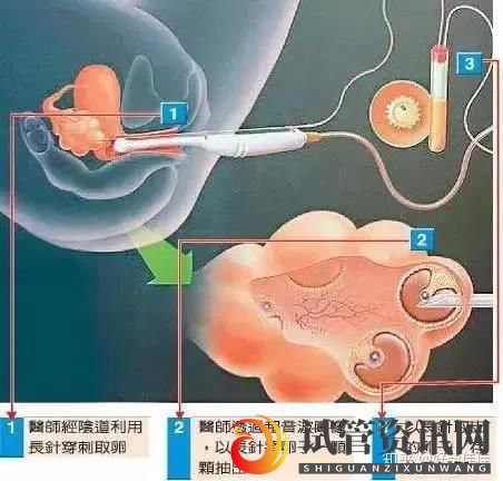 试管婴儿痛吗花一分钟看完你就知道了!(图1)