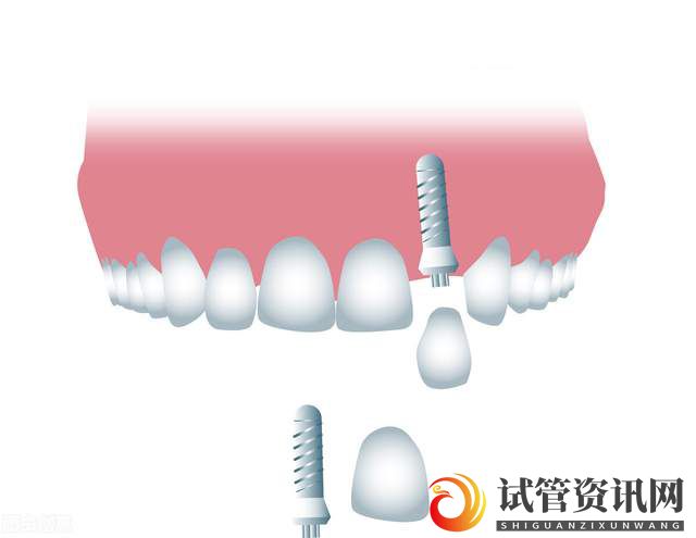 在廊坊，种植牙的过程真的痛苦到难以忍受吗？(图1)