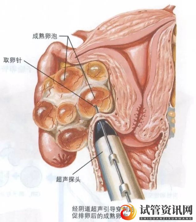 冻卵这件事,你真要趁早了解(图5)