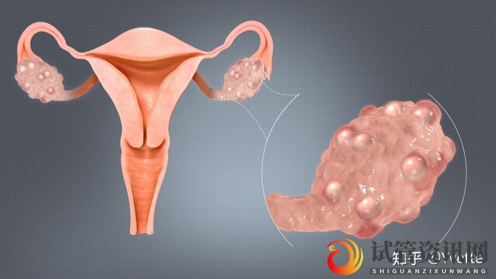 我的多囊卵巢综合征(PCOS)经历(图1)