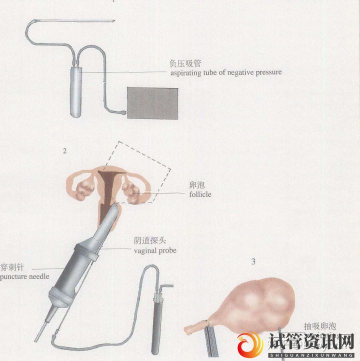 干货_女性取卵全过程(图3)