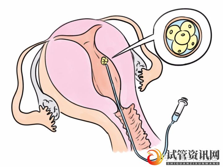 试管适应症_第一代试管婴儿(图1)