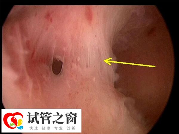 宫腔镜下做宫腔粘连分离手术