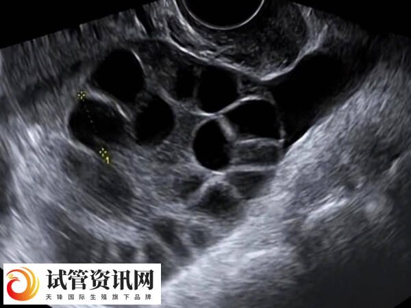 促排过程中卵巢体积会出现增大